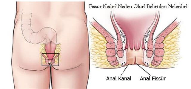 Makat Çatlağı Nedir, Belirtileri Nelerdir?