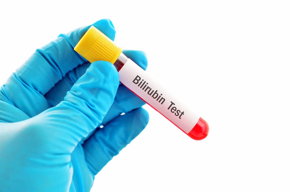 Bilirubin testi nedir?