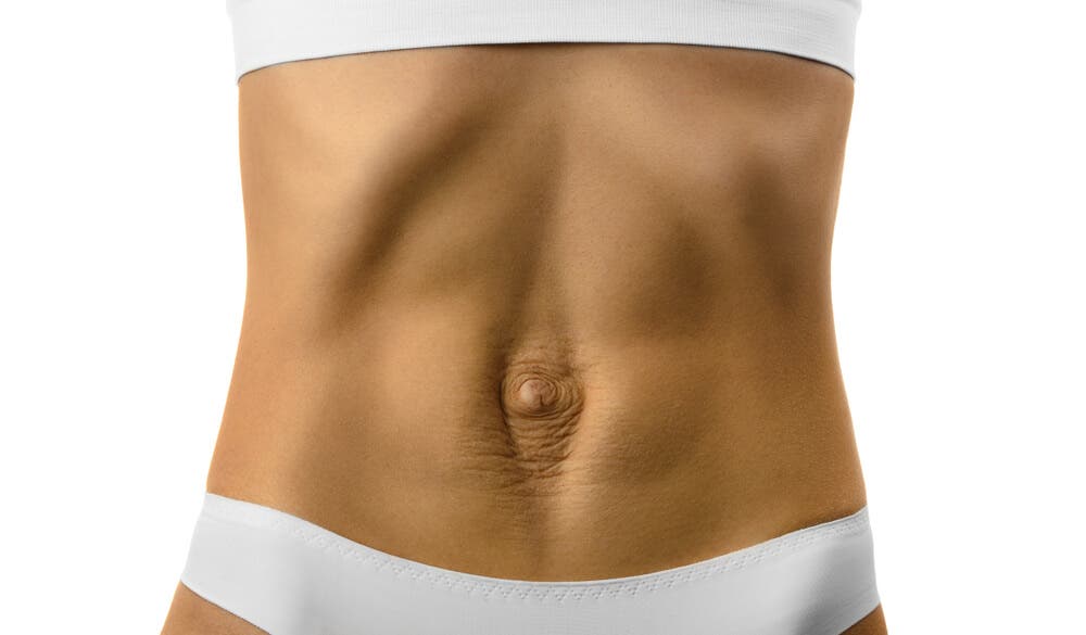 Diastasis recti nedir, nasıl iyileşir?