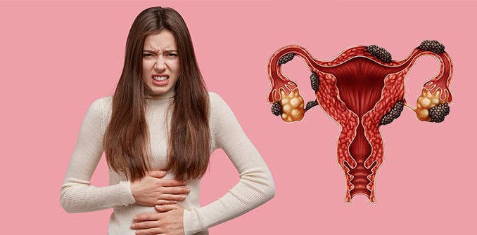 Çikolata Kisti (Endometriozis): Nedenleri, Belirtileri ve Tedavisi