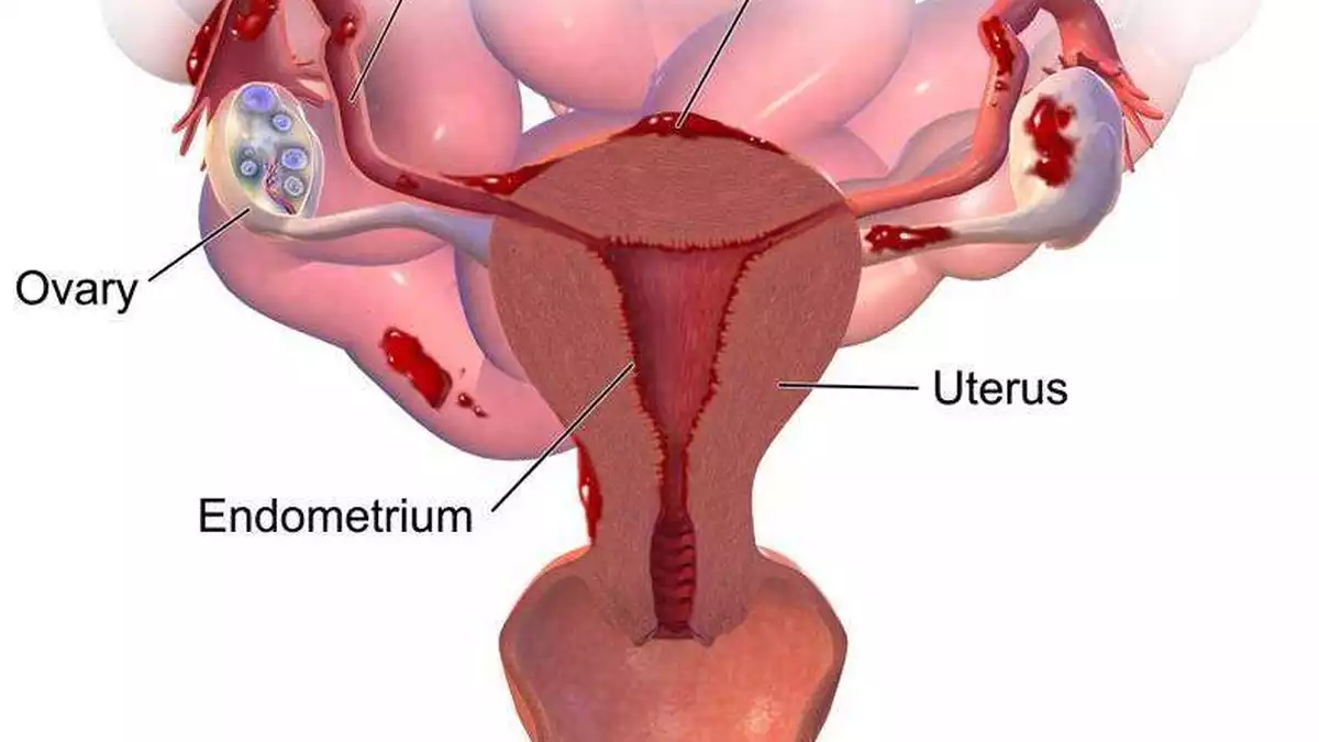 Yumurtalık Büyümesi Nedir?