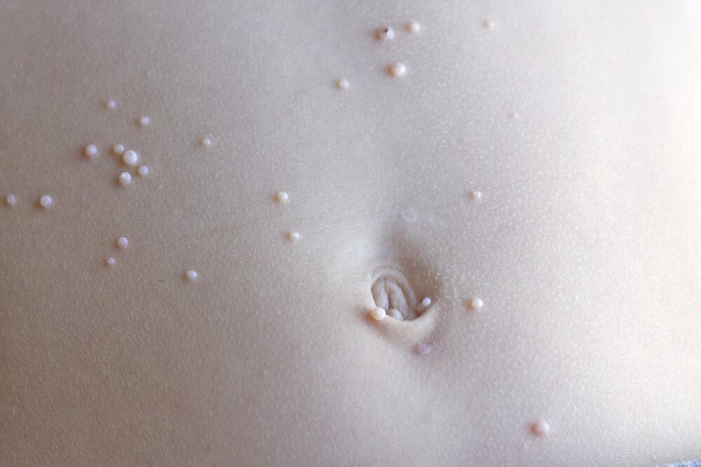 Molluskum contagiosum nedir, neden olur?